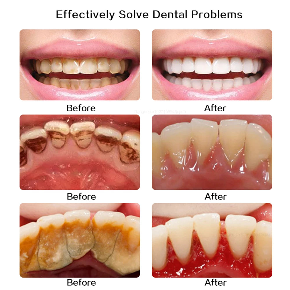 Ultrasonic Dental Tartar Cleaner Electric Tooth Polisher Tartar Eliminator Teeth Whitening Dental Calculus Plaque Tartar Remover