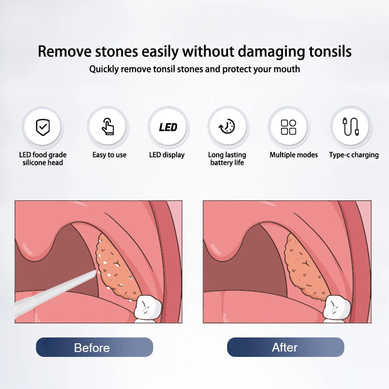 Electric Tonsil Stone Remover Tonsil Stone Removal Kit Vacuum With Irrigation Syringe Instant Suction Tonsil Stone Removal
