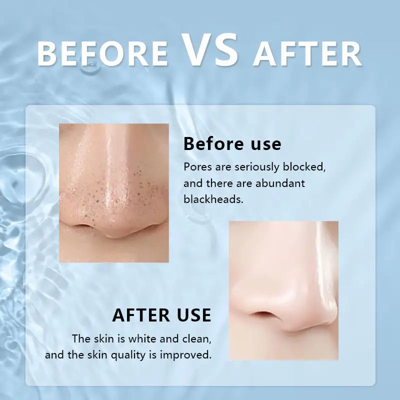 Electric Black Head Instrument Acne Removal Machine Tool Pore Cleaner Vacuum Blackhead Remover